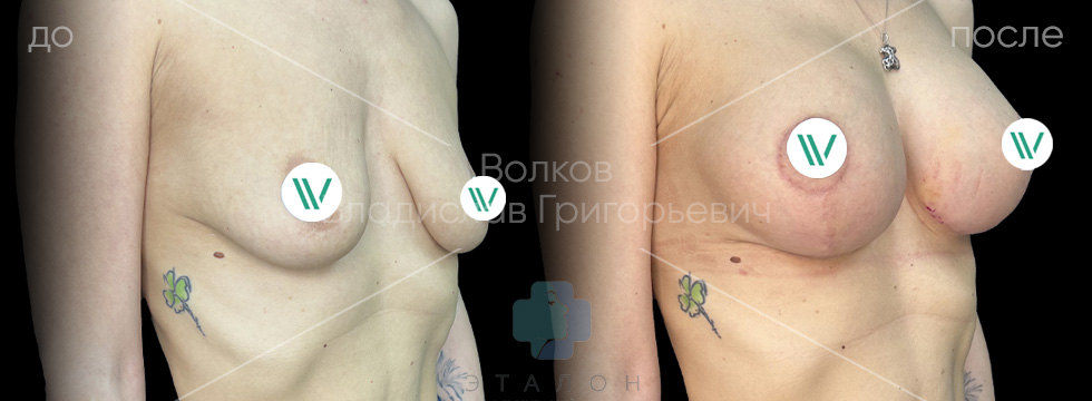 Подтяжка груди