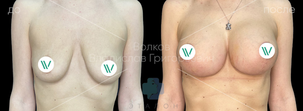 Подтяжка груди