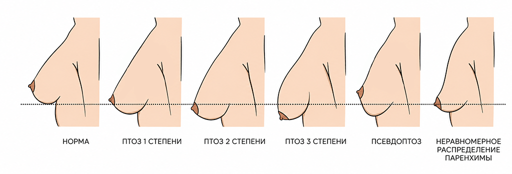 степени птоза женской груди
